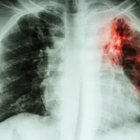 fibrose-pulmonaire-idiopathique