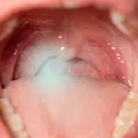 tumeurs-benignes-de-la-cavite-buccale