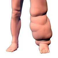 filariose-lymphatique