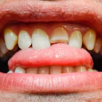 fracture-de-lemail-dentaire