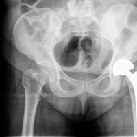 fracture-de-la-hanche